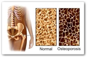 COMO PREVENIR LA OSTEOPOROSIS1