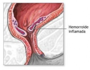 hemorroides-inflamada