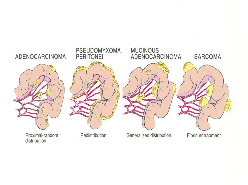 cancer peritoneal pronostico)
