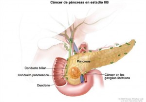 Cáncer de Pancreas en estadio IIB