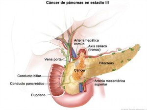 Cáncer de páncreas en estadio III