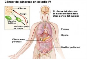 Cáncer de páncreas en estadio IV