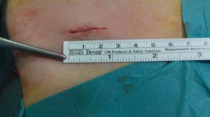 Cicatriz extirpación apéndice vía laparoscópica