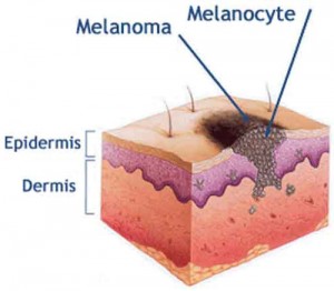 Avance del Melanoma en la dermis