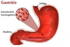gastritis 2