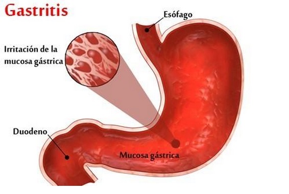Recomendaciones dietéticas en la gastritis - Instituto Quirúrgico ...